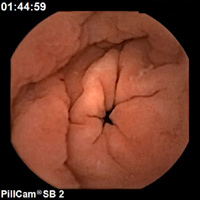 A photograph of the inside of the stomach taken by a self-propelling capsule endoscope